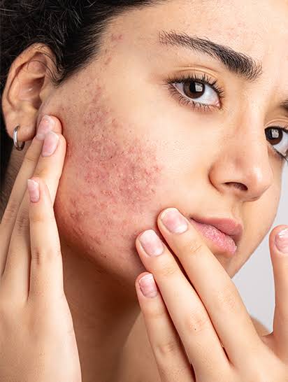 The Acne Recovery Guide